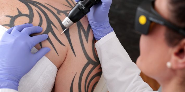Tattoo Removal