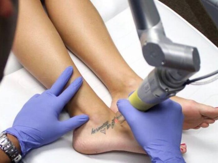 8 things to know before getting laser tattoo removal